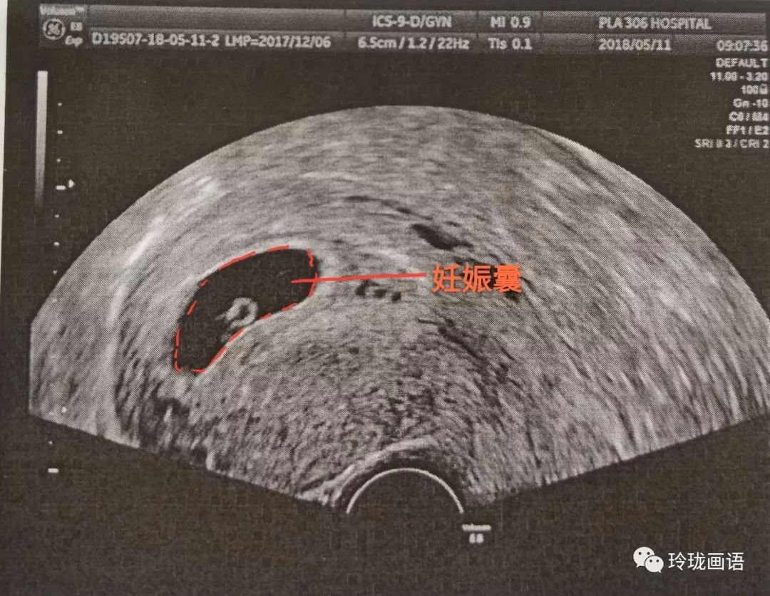 产检B超，那些数字到底什么意思_周玲_副主任医师_爱问健康