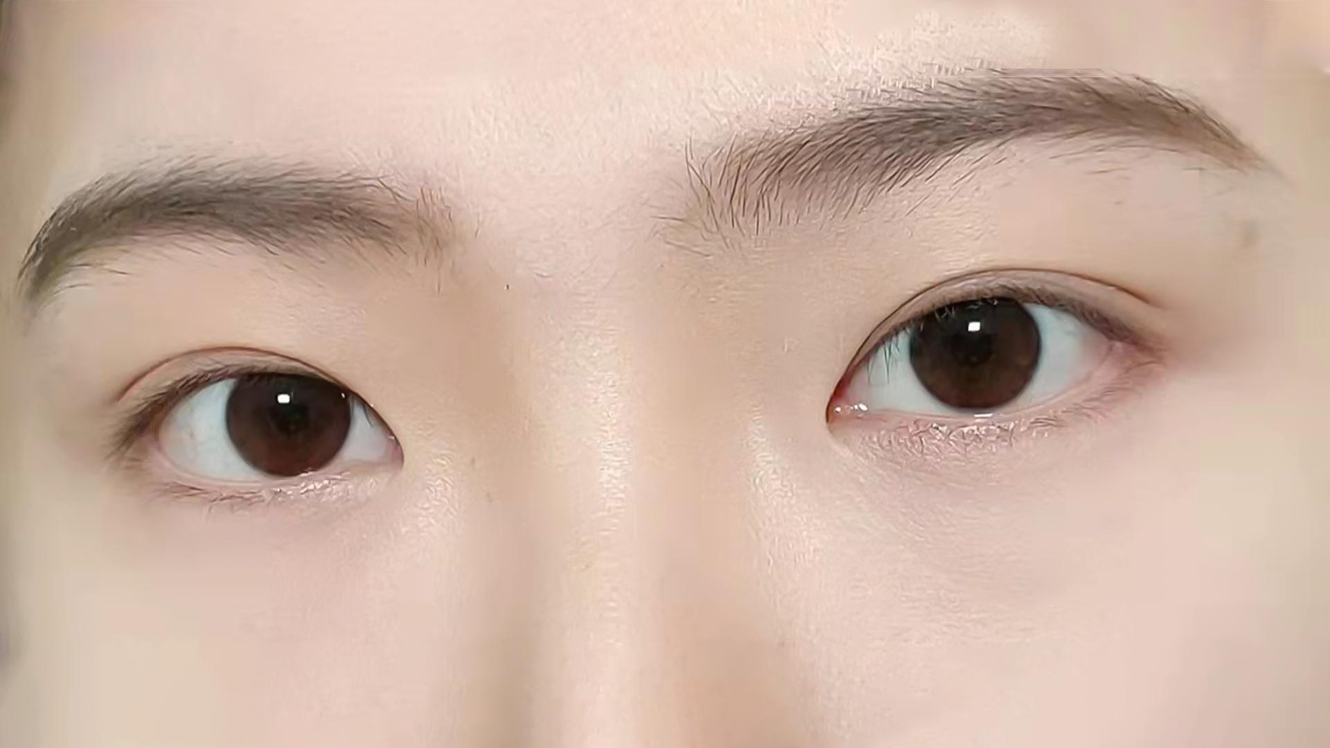 双眼皮形态做了平行型显老不自然怎么办?做双眼皮修复可以改善_孔宇_主任医师_爱问健康