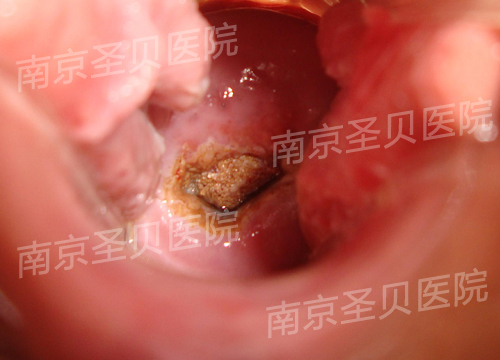 尖锐恐惧症图片 针尖图片