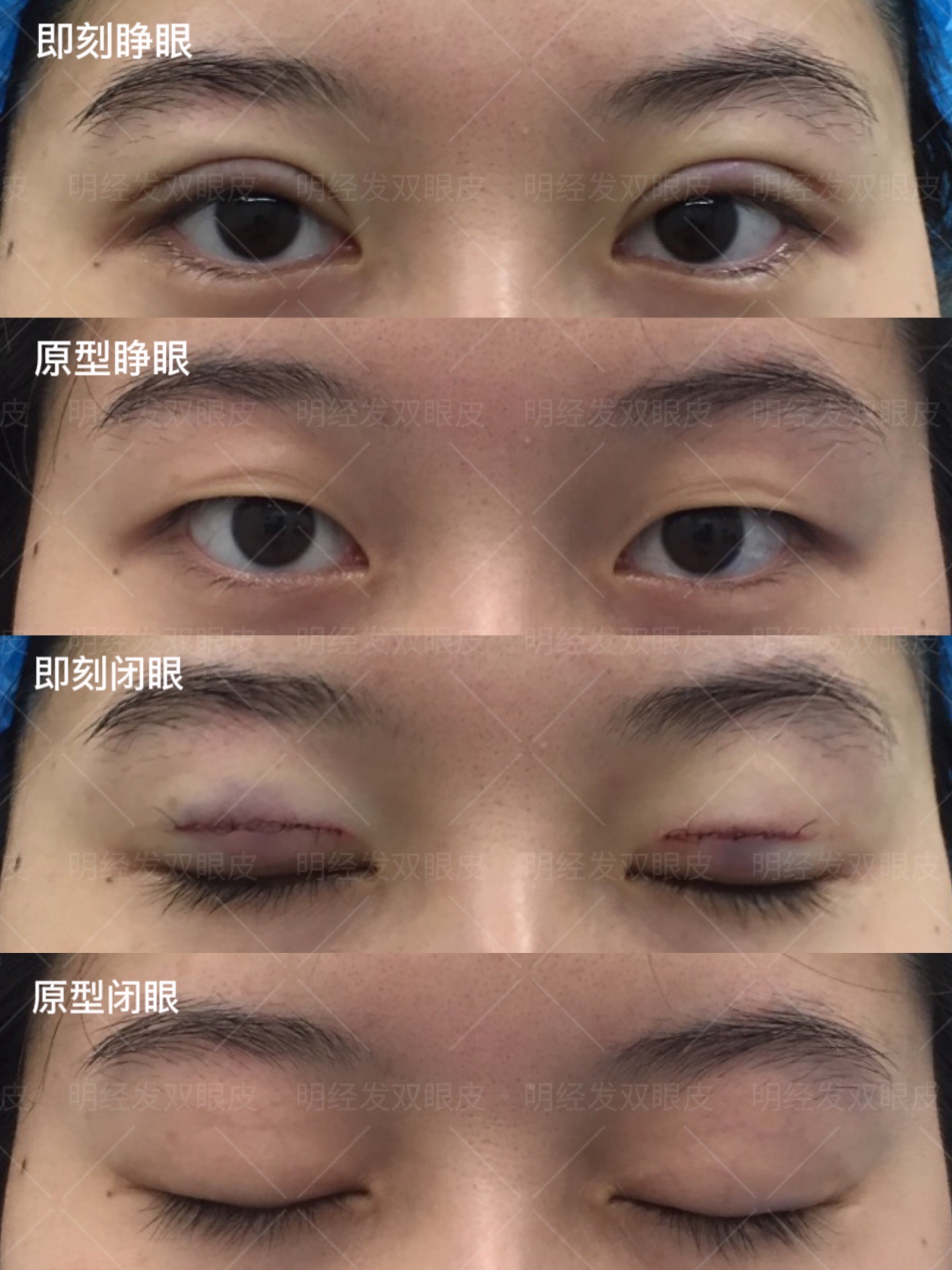 做双眼皮到底是选埋线还是全切呢?_明经发_主治医师_爱问健康