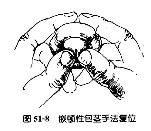 在此再次提醒各位,科学摆放你的包皮,不要随意把包皮翻出来置之不理