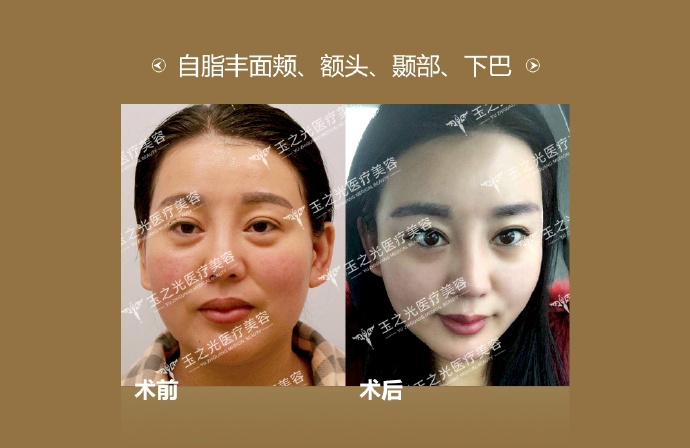 北京自体脂肪丰面颊、额头....对比图.jpg