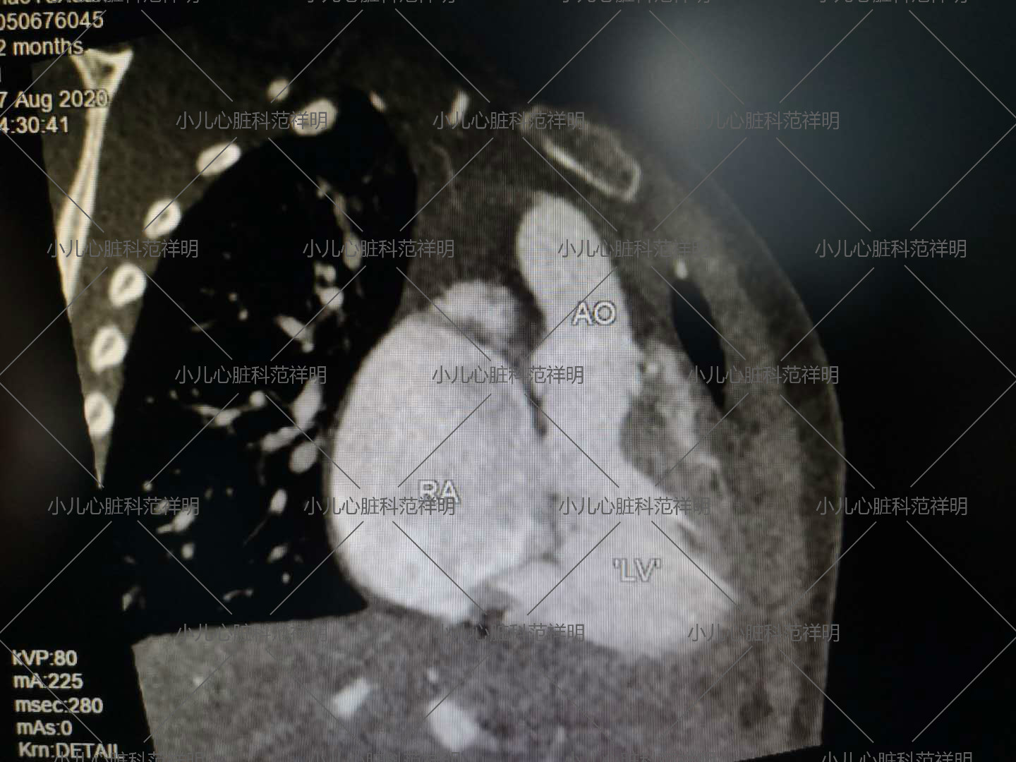 全世界只有几十例的罕见病：孤立性心室反位范祥明主任医师爱问健康 