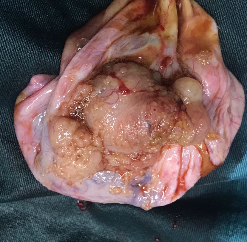 诊间日记:双侧卵巢浆液性囊腺癌