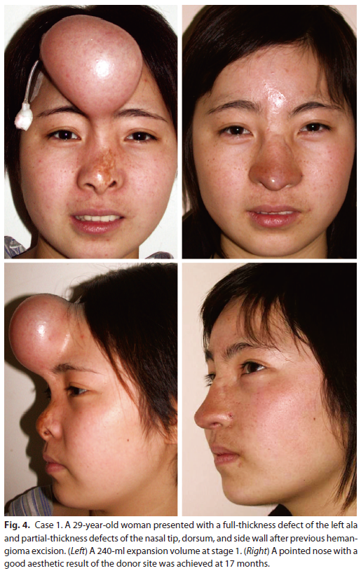 鼻缺损的修复重建