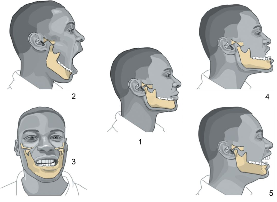 颞颌关节脱位的原因是什么
