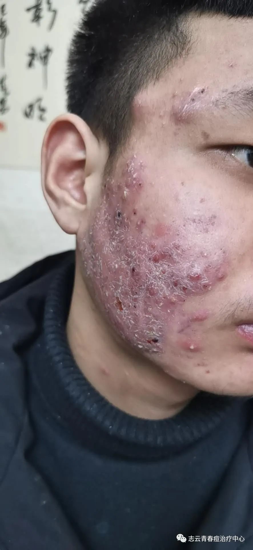 脸上红肿的大痘痘怎么形成的?怎么治疗红肿的痘痘?