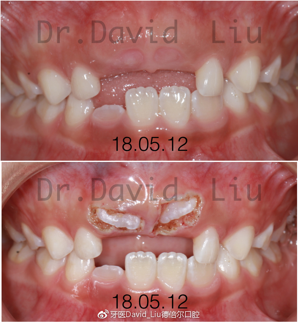 门牙助萌手术切口图片图片