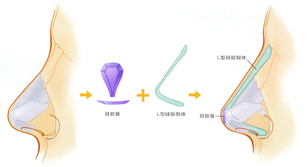 耳软骨 l型硅胶假体隆鼻--示意.jpg