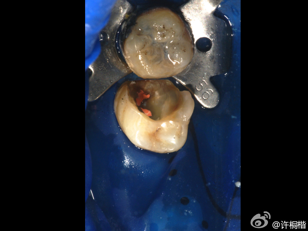 为什么牙医不用开口器初试Ivoclar大块充填（bulk fill）树脂_https://www.jmylbn.com_新闻资讯_第2张