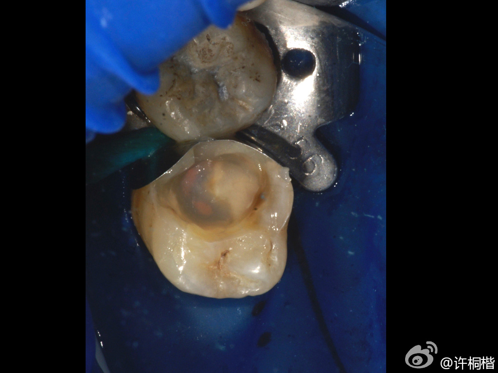 为什么牙医不用开口器初试Ivoclar大块充填（bulk fill）树脂_https://www.jmylbn.com_新闻资讯_第4张