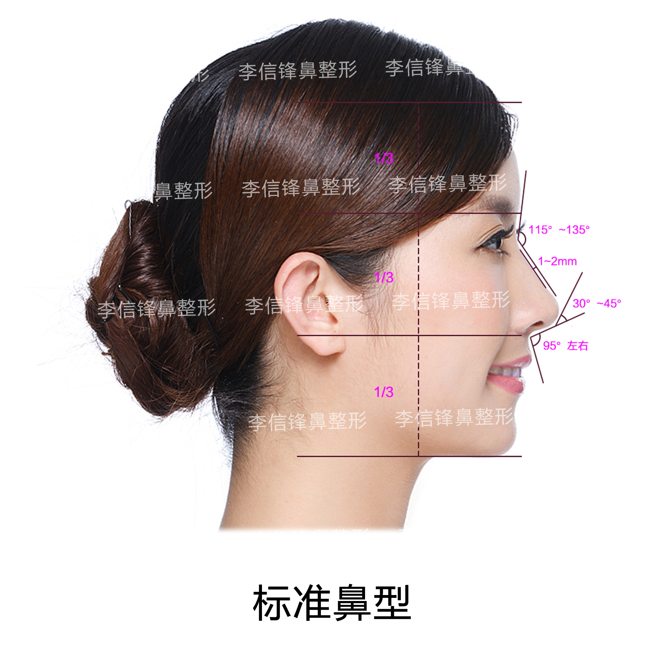 轻度鞍鼻:鼻梁低而鼻尖大