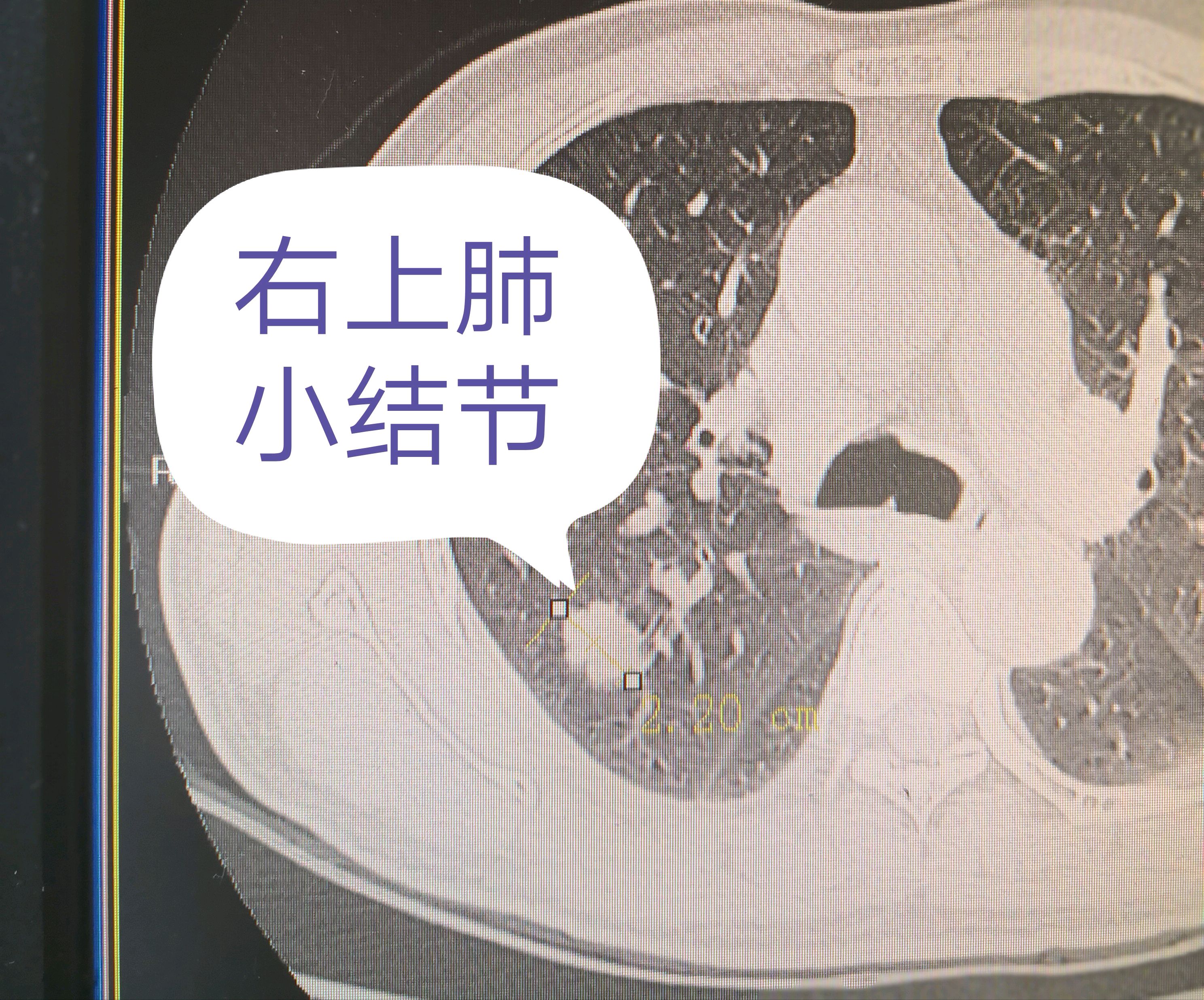 没想到做胸片就发现肺小结节