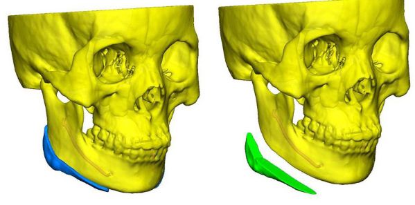 3d打印技术应用于下颌角手术模拟术后效果降低心理负担大家都知道,往