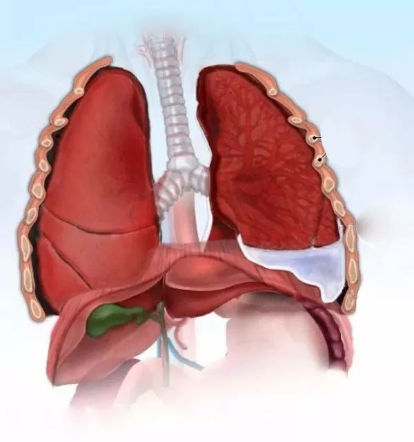 胸腔积液红色图片