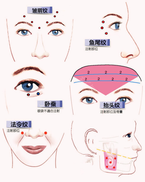 改善方法:注射肉毒素注射可以减少肌肉活动,能够减轻减缓法令纹的形成