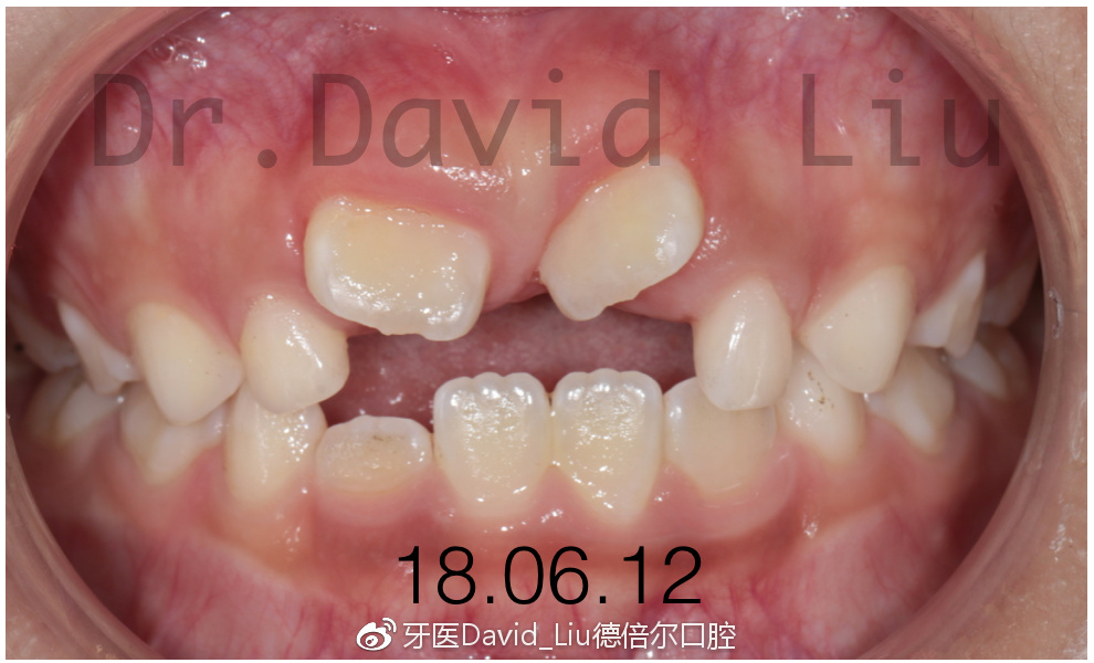 恒牙萌出阻力过大,不能正常萌出,不得不做助萌术,激光在临床的应用也