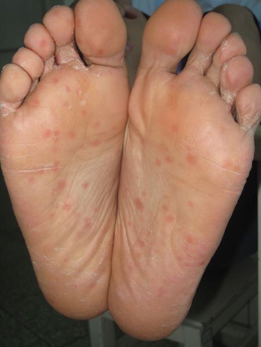 (下图展示的是典型的脚掌二期梅毒疹,勿对号入座)2)假如这位母亲至始