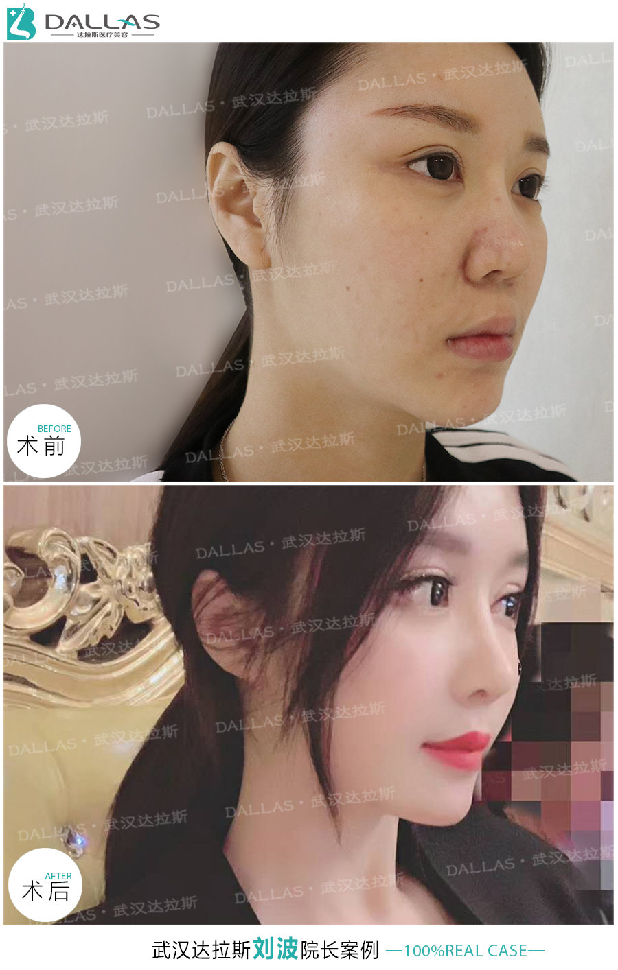 半肋鼻综合第五次修复术真实案例分享_刘波_主治医师_爱问健康