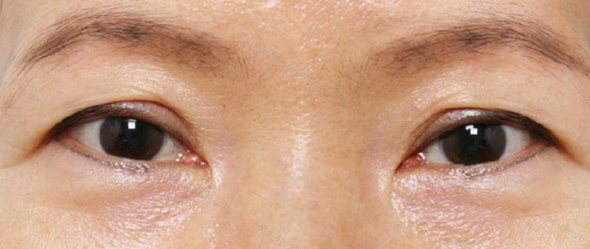 组织萎缩,真皮层渐渐变薄,再加上重力作用,上眼睑皮肤本身会出现松弛