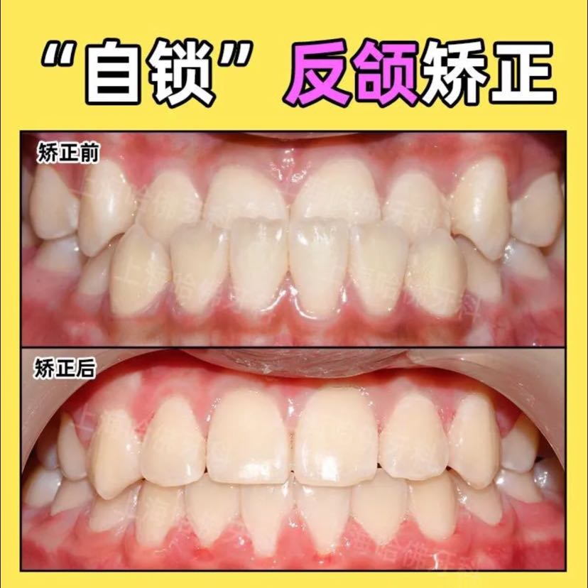 小朋友地包天别放弃,试试牙齿矫正73