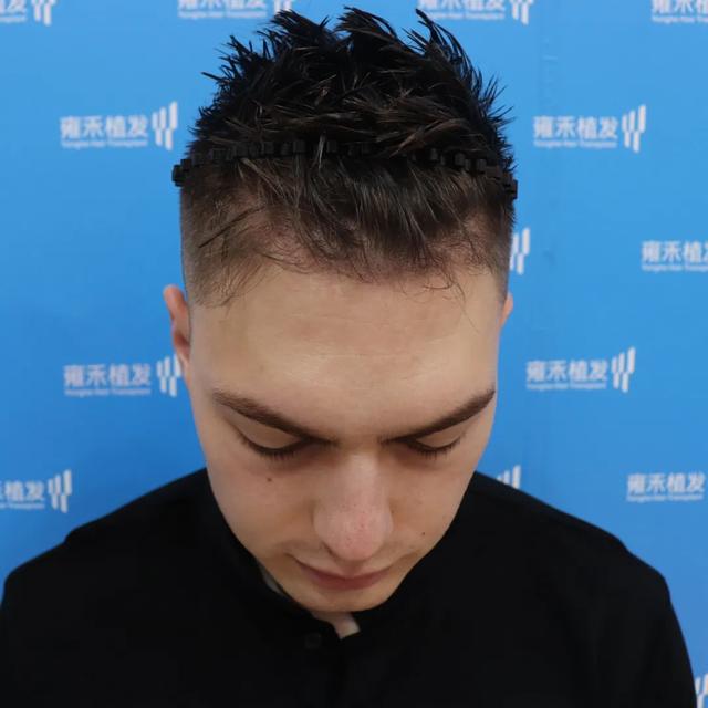 为什么出国留学就开始脱发?(附带外国小哥额角改善案例参考)_刘长春_主任医师_爱问健康