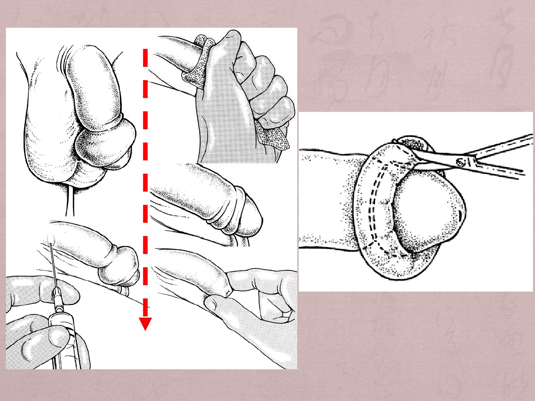 嵌顿包茎怎么自己解决图片