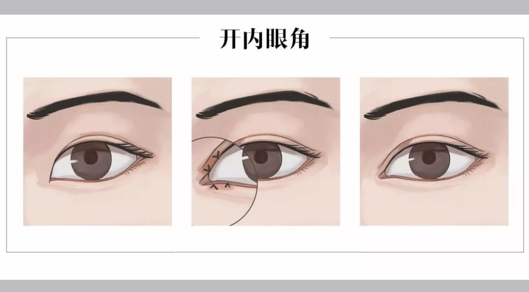 开内眼角.jpg