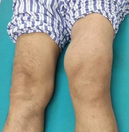 【膝盖积液】抽积液后总是反复，如何正确根治？