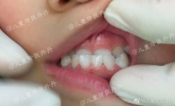 牙齿反颌,俗称"地包天"或"兜齿".