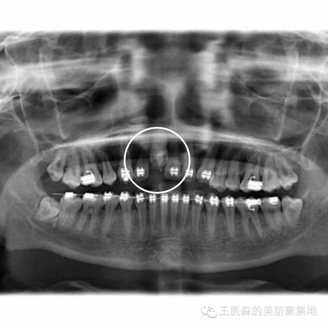 王文婷医生：“没有门牙”的公举，你们听过阻生牙吗？_爱问健康