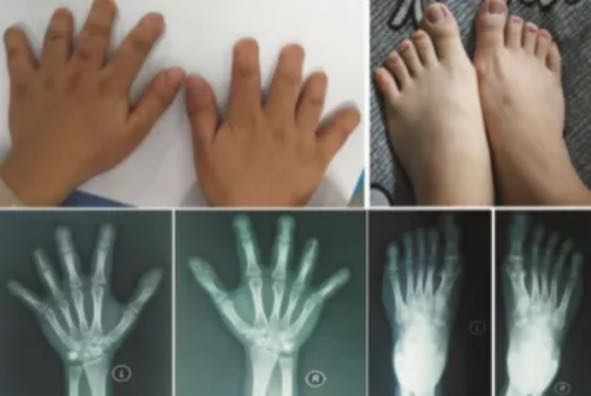 短指综合症合并身材矮小，是个什么病？_李利平_主任医师_爱问健康
