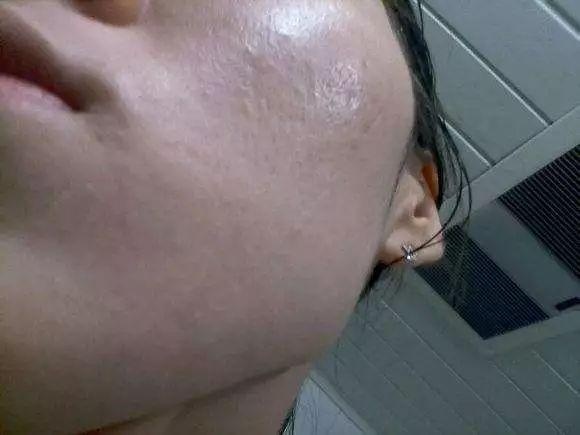 有一种疹子,叫激素脸逆光疹!