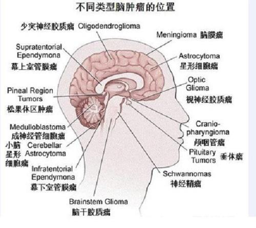 颅内肿瘤