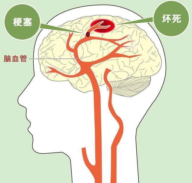 脑梗位置图片图片