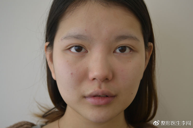 鼻子打了3年的玻尿酸,导致变得非常宽.