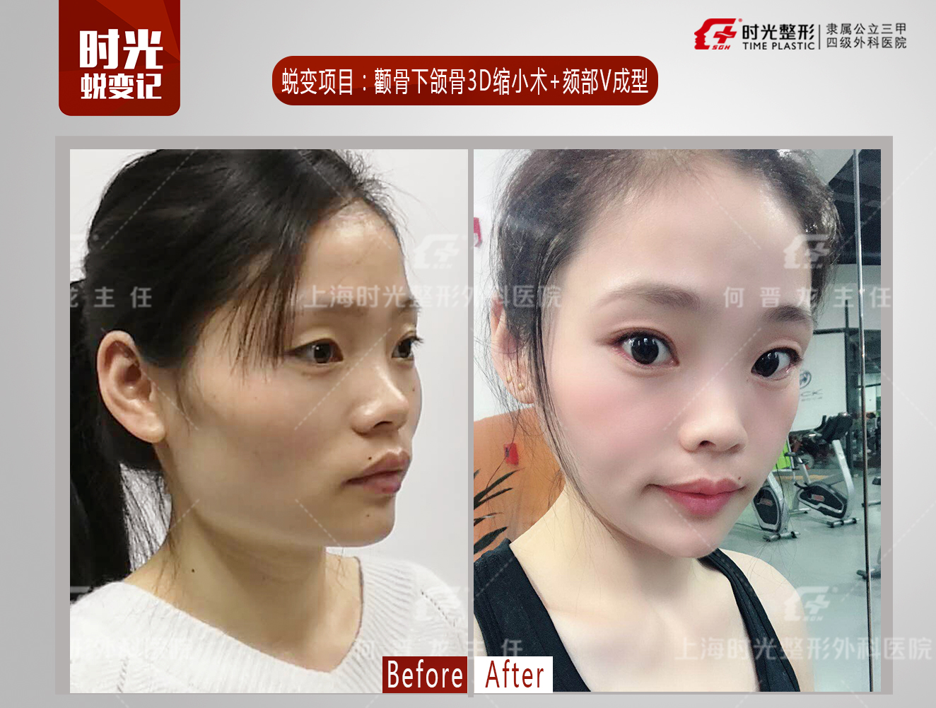 浅谈颏v —截骨前移术_何晋龙_副主任医师_爱问健康