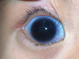 先天性青光眼.jpg