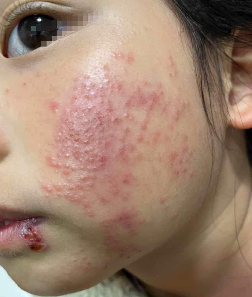 疱疹样湿疹,究竟是疱疹还是湿疹?