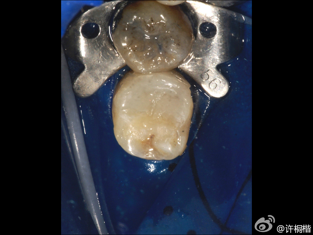 为什么牙医不用开口器初试Ivoclar大块充填（bulk fill）树脂_https://www.jmylbn.com_新闻资讯_第5张