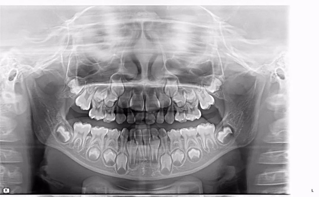 儿童牙齿全景片图片