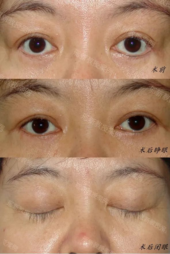 术前术后正位对比照术后:6个月后,矫正了下睑退缩,下睑露白改善,凶狠