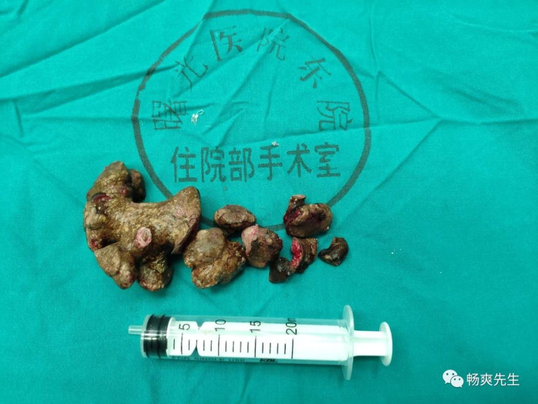 肾铸型结石病例_葛旻垚_副主任医师_爱问健康