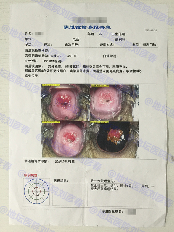 tct结果显示ascus该怎么办?