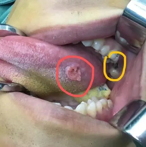 舌癌早期疼吗图片