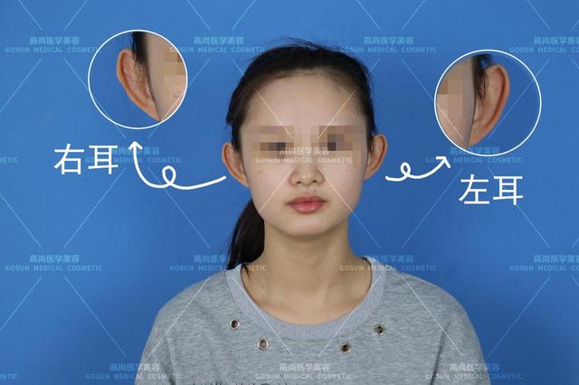 【案例】女生有一双招风耳是什么体验?为了摆脱招风耳她做了招风