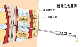 硬膜外麻醉和腰麻区别图片