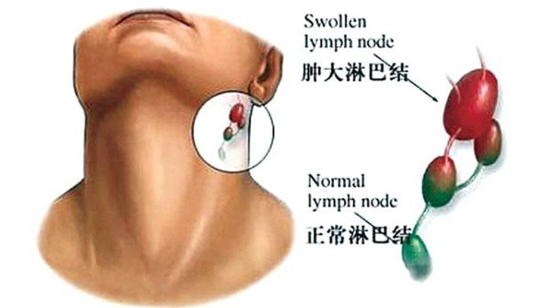 怎样鉴别宝宝淋巴结有没有炎症?