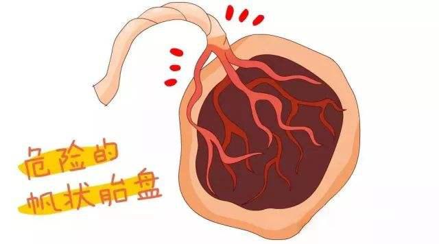 怀孕期间如何筛查前置血管?前置血管有什么高危因素?你都了解吗_刘淼_副主任医师_爱问健康