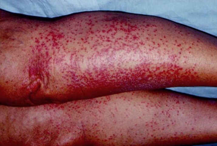 深在痱miliaria profunda,反复发作的红痱,因炎性细胞积聚增多,可以